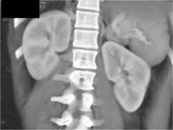 Acute Pyelonephritis - CTisus CT Scan