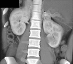 Acute Pyelonephritis - CTisus CT Scan