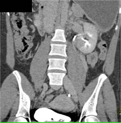 Acute Pyelonephritis - CTisus CT Scan