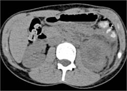 Renal Abscess - CTisus CT Scan