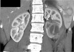 Renal Abscess - CTisus CT Scan