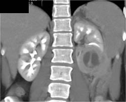 Renal Abscess - CTisus CT Scan