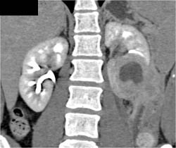 Renal Abscess - CTisus CT Scan