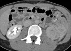 Renal Abscess - CTisus CT Scan