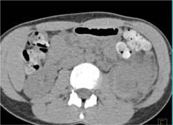 Renal Abscess - CTisus CT Scan