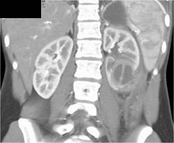 Renal Abscess - CTisus CT Scan