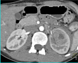 Renal Abscess - CTisus CT Scan