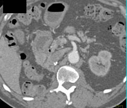 Post Right Nephrectomy With Local Recurrence Near Duodenum - CTisus CT Scan