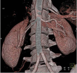 Prehilar Branching Right Renal Artery and 2 Left Renal Arteries - CTisus CT Scan