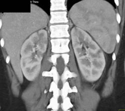 Acute Pyelonephritis - CTisus CT Scan