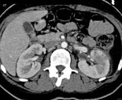 Acute Pyelonephritis - CTisus CT Scan