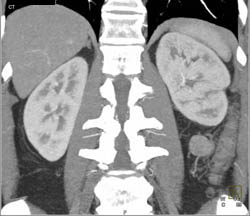 Acute Pyelonephritis - CTisus CT Scan