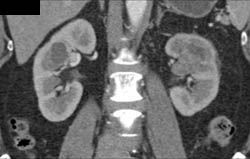 Transitional Cell Carcinoma- See Sequence of Images - CTisus CT Scan