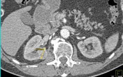 1cm Subtle Renal Cell Carcinoma - CTisus CT Scan