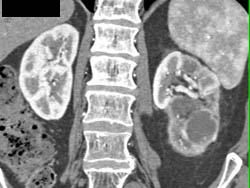 Left Renal Cell Carcinoma - CTisus CT Scan