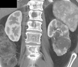 Left Renal Cell Carcinoma - CTisus CT Scan