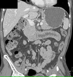 Thickened Small Bowel Near Left Kidney - CTisus CT Scan