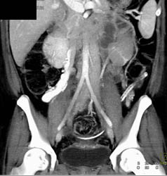 Huge Varices Near Right Kidney - CTisus CT Scan