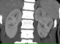 Acute Pyelonephritis - CTisus CT Scan