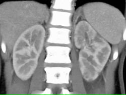 Acute Pyelonephritis - CTisus CT Scan