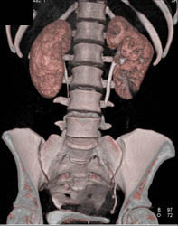 Acute Pyelonephritis - CTisus CT Scan