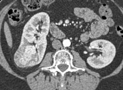 Renal Cell Carcinoma - CTisus CT Scan