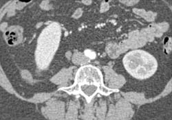 Renal Cell Carcinoma - CTisus CT Scan