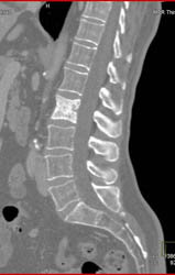 Blastic Metastases From Renal Cell Carcinoma - CTisus CT Scan