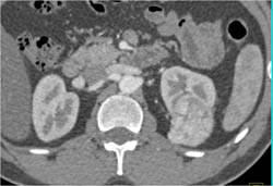 Vascular Renal Cell Carcinoma in Various Renderings - CTisus CT Scan