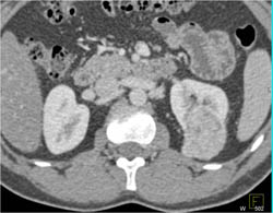 Renal Cell Carcinoma - CTisus CT Scan