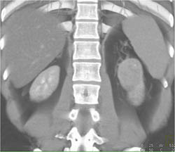 Renal Cell Carcinoma - CTisus CT Scan