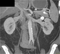 Renal Artery Aneurysm - CTisus CT Scan