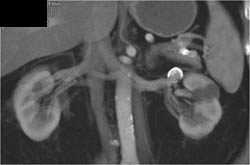 Renal Artery Aneurysm - CTisus CT Scan