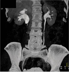 Retroperitoneal Fibrosis - CTisus CT Scan