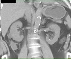 Perirenal Bleed on Right - CTisus CT Scan