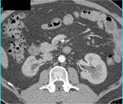 2 Renal Arteries to Each Kidney - CTisus CT Scan