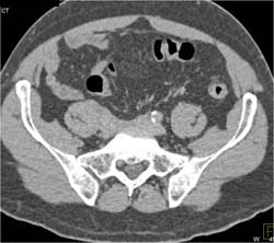 Retroperitoneal Fibrosis - CTisus CT Scan