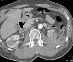 Post Partial Nephrectomy With Abscess - CTisus CT Scan