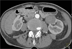 Renal Cell Carcinoma - CTisus CT Scan