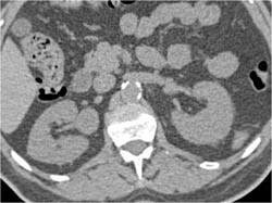 Transitional Cell Carcinoma of Right Renal Pelvis - CTisus CT Scan