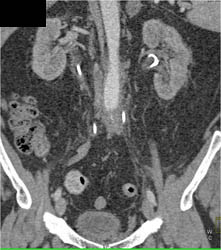 Retroperitoneal Fibrosis - CTisus CT Scan