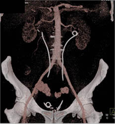 Retroperitoneal Fibrosis - CTisus CT Scan