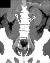 Retroperitoneal Fibrosis - CTisus CT Scan