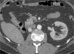 Recurrent Renal Cell Carcinoma S/P Nephrectomy - CTisus CT Scan