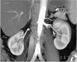 2 Left Renal Arteries - CTisus CT Scan