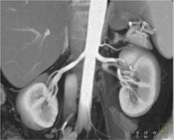 2 Left Renal Arteries - CTisus CT Scan