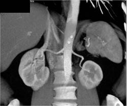 Horseshoe Kidney - CTisus CT Scan