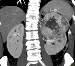 Hypervascular Renal Cell Carcinoma With Extensive Neovascularity - CTisus CT Scan