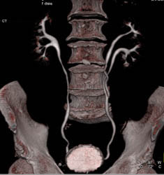 Partial Duplication of the Left Collecting System - CTisus CT Scan