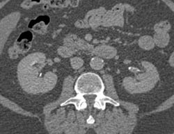 Transitional Cell Cancer (TCC) of Left Kidney - CTisus CT Scan